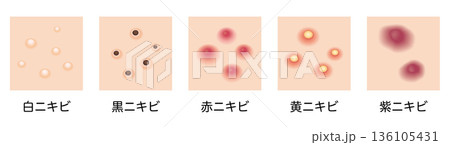 ニキビのタイプ　5種セット 136105431
