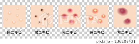 ニキビのタイプ　5種セット 136105431