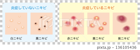 Illustration of types of acne | With and without inflammation 136105436