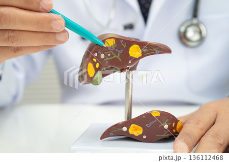 Cirrhosis, Liver cancer, fatty liver, Asian doctor with liver human model. Cirrhosis, Liver cancer, fatty liver, Asian doctor with liver human model. 136112468