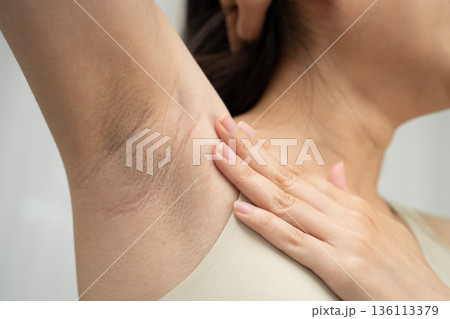 Asian woman have problem black armpit beauty skin care. 136113379