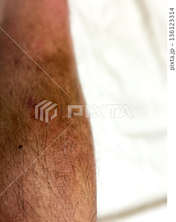 男性のすねにできた皮脂欠乏性湿疹 136123314