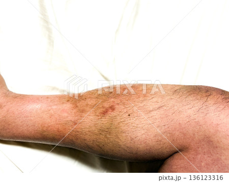 男性のすねにできた皮脂欠乏性湿疹 136123316