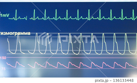 Medical monitor displaying patient vital signs, heartbeat, pulse, and EKG data 136133448