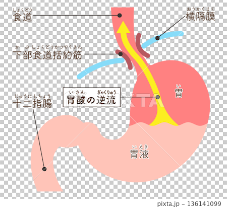 Acid reflux illustration Acid reflux illustration 136141099