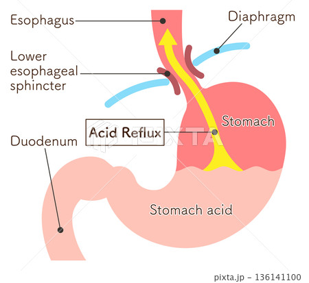 胃酸の逆流のイラスト　Acid reflux illustration 136141100
