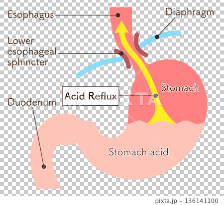 胃酸の逆流のイラスト　Acid reflux illustration 136141100