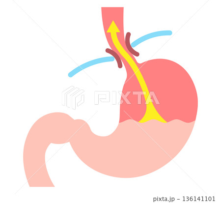 胃酸の逆流のイラスト　Acid reflux illustration 136141101