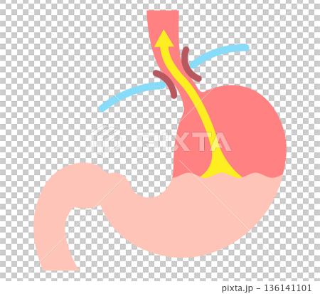 胃酸の逆流のイラスト　Acid reflux illustration 136141101