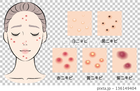 一位患有痤瘡的年輕女子，痤瘡類型多種多樣。 136149404