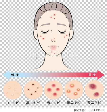 一系列痤瘡類型以及一位患有痤瘡的女性的臉部照片 136149405