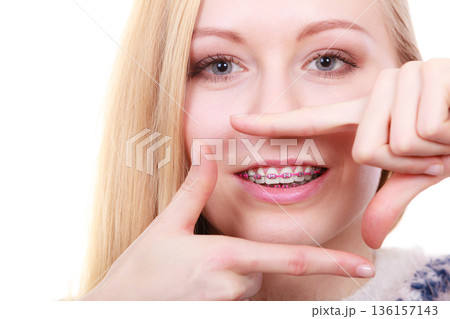 Happy woman showing her braces on teeth 136157143