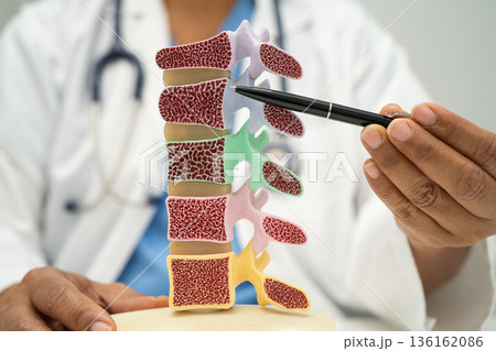 Doctor holding osteoporosis in back bone model for treatment medical. Doctor holding osteoporosis in back bone model for treatment medical. 136162086