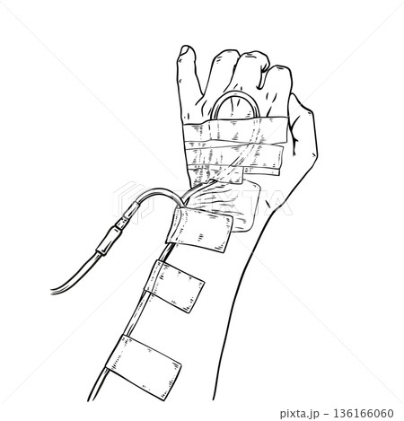 Saline Infusion, line drawing 136166060