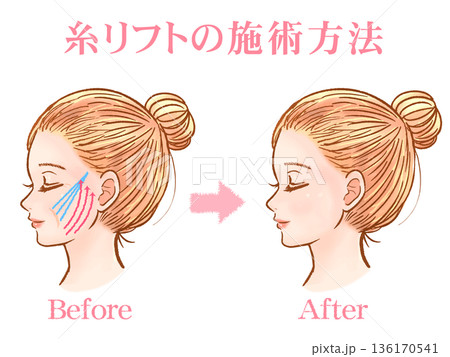 美容整形で糸リフトを受ける大人女性の素材 136170541