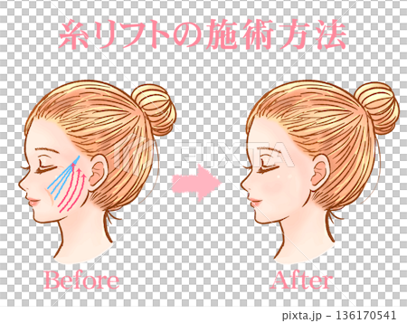 美容整形で糸リフトを受ける大人女性の素材 136170541