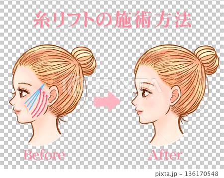 一名成年女性接受線雕提升整形手術的素材 2 136170548