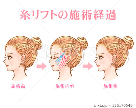 美容整形で糸リフトを受ける大人女性の素材3 136170549