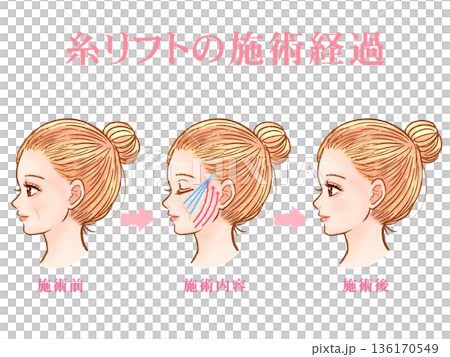 美容整形で糸リフトを受ける大人女性の素材3 136170549