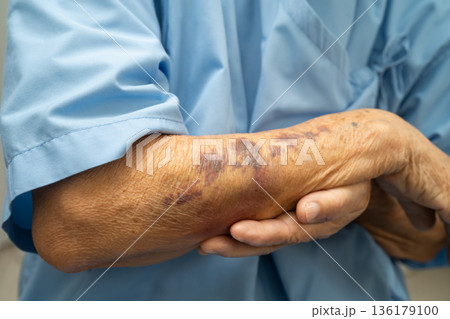 Ecchymosis, elderly bleeding on her arm after taking aspirin. 136179100