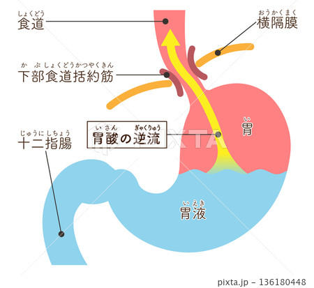 胃酸の逆流のイラスト　Acid reflux illustration 136180448