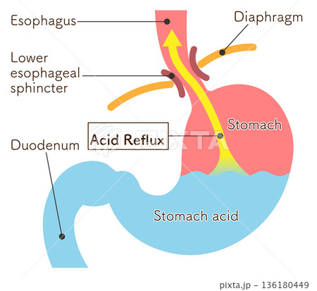 胃酸の逆流のイラスト　Acid reflux illustration 136180449