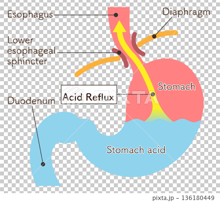 胃酸の逆流のイラスト　Acid reflux illustration 136180449