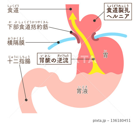 食道裂孔ヘルニアのイラスト　Hiatal hernia illustration 136180451