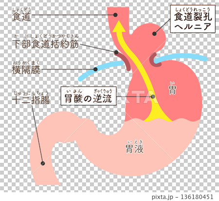 食道裂孔疝氣示意圖 136180451