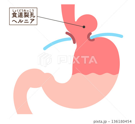 食道裂孔ヘルニアのイラスト Hiatal hernia illustration 食道裂孔ヘルニアのイラスト Hiatal hernia illustration 136180454