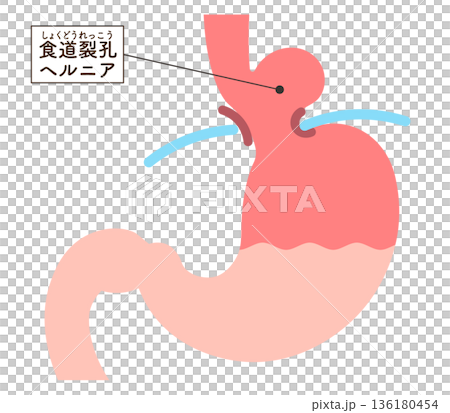 食道裂孔疝氣示意圖 食道裂孔疝氣示意圖 136180454