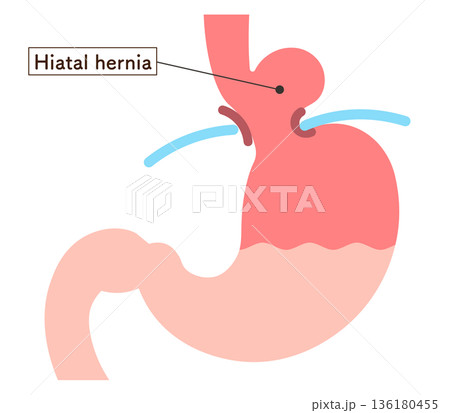 食道裂孔ヘルニアのイラスト Hiatal hernia illustration 食道裂孔ヘルニアのイラスト Hiatal hernia illustration 136180455