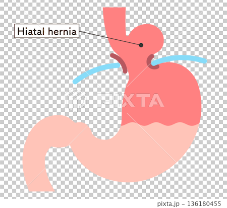 食道裂孔ヘルニアのイラスト Hiatal hernia illustration 食道裂孔ヘルニアのイラスト Hiatal hernia illustration 136180455
