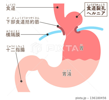 食道裂孔ヘルニアのイラスト Hiatal hernia illustration 食道裂孔ヘルニアのイラスト Hiatal hernia illustration 136180456