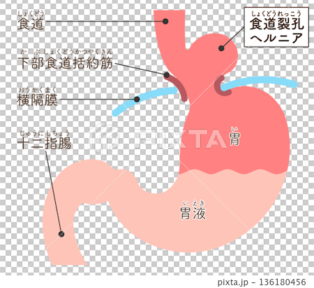 Hiatal hernia illustration Hiatal hernia illustration 136180456
