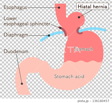 Hiatal hernia illustration Hiatal hernia illustration 136180457