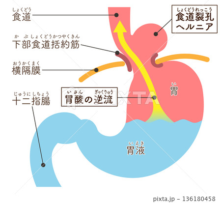 食道裂孔ヘルニアのイラスト　Hiatal hernia illustration 136180458