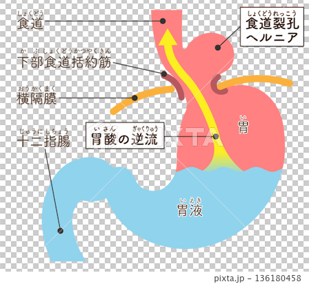 食道裂孔ヘルニアのイラスト　Hiatal hernia illustration 136180458
