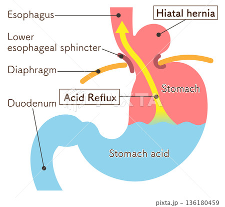 食道裂孔ヘルニアのイラスト Hiatal hernia illustration 食道裂孔ヘルニアのイラスト Hiatal hernia illustration 136180459