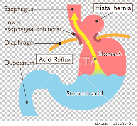 食道裂孔ヘルニアのイラスト Hiatal hernia illustration 食道裂孔ヘルニアのイラスト Hiatal hernia illustration 136180459
