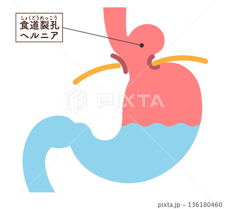 食道裂孔ヘルニアのイラスト　Hiatal hernia illustration 136180460