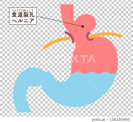 食道裂孔ヘルニアのイラスト　Hiatal hernia illustration 136180460