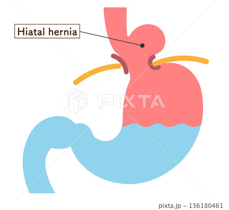食道裂孔ヘルニアのイラスト Hiatal hernia illustration 食道裂孔ヘルニアのイラスト Hiatal hernia illustration 136180461