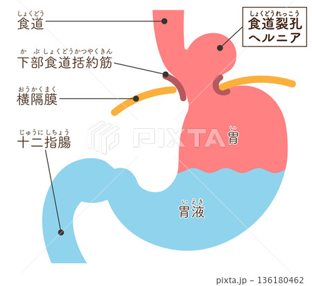 食道裂孔ヘルニアのイラスト　Hiatal hernia illustration 136180462