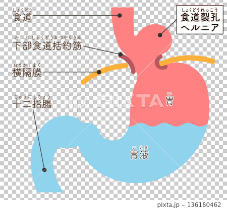 食道裂孔ヘルニアのイラスト　Hiatal hernia illustration 136180462