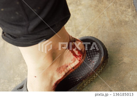 山ヒルに噛まれた傷からの流血　ネパール 136185013