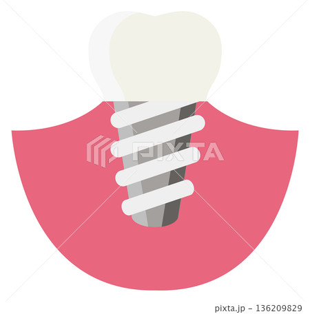 Tooth implant. Dental medical treatment color icon 136209829