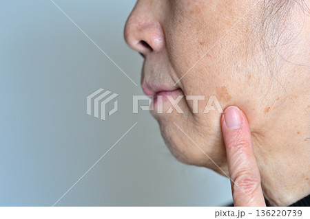 顔のシミ・シワ・ソバカス・ホクロ・イボに悩むシニア女性 136220739
