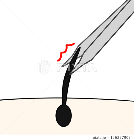 ピンセットで毛を抜く 136227902