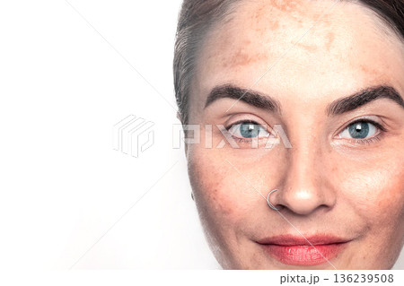 Caucasian woman shows face with pigmentation, melasma, freckles, age spots photo close up on white copy space 136239508